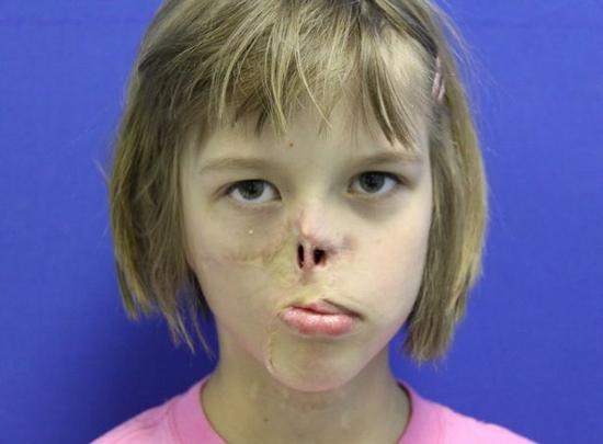 美国女孩被浣熊撕掉半边脸 肋部软骨助其恢复