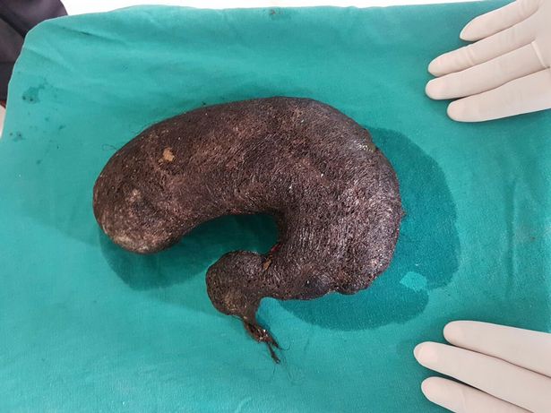 印16岁暴瘦女孩患食毛症 医生从胃部取出2公斤