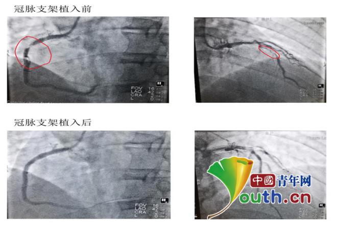 铅衣人再套防护服生死时速抢回防疫志愿者生命