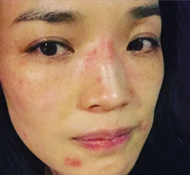 舒淇崩溃晒自拍照 脸部红肿过敏堪比毁容颇为无奈 舒淇崩溃晒自拍照 脸部红肿过敏堪比毁容颇为无奈
