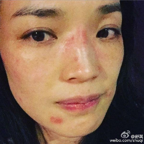 舒淇崩溃晒自拍照 网友分享各式抗过敏妙招