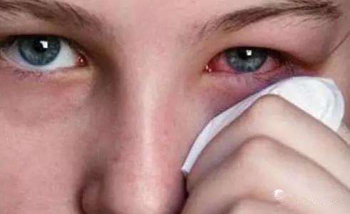 睫毛里爬出3条虫 睫毛里爬出3条虫