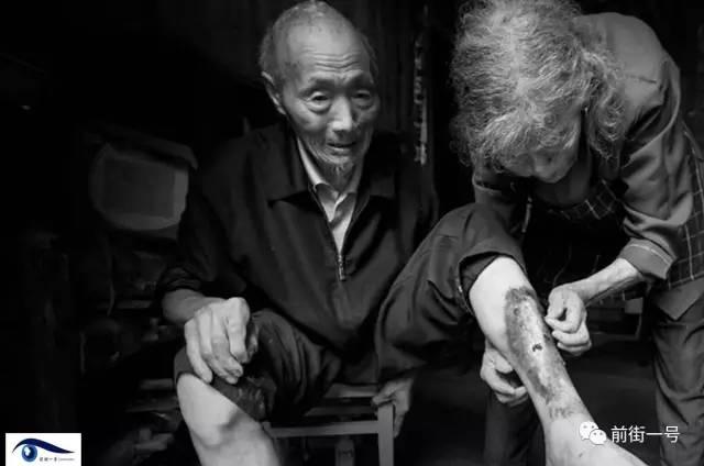 二战细菌战受害老人接受治疗 伤口渗血持续半