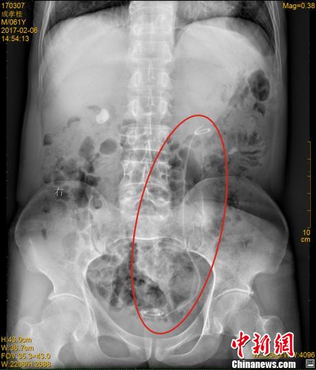 男子体内现30厘米导管 腹中隐藏7年导管牵出重大医疗事故