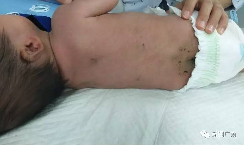 泉州40天男婴被扎30多针 只因外婆听信土方找人放血