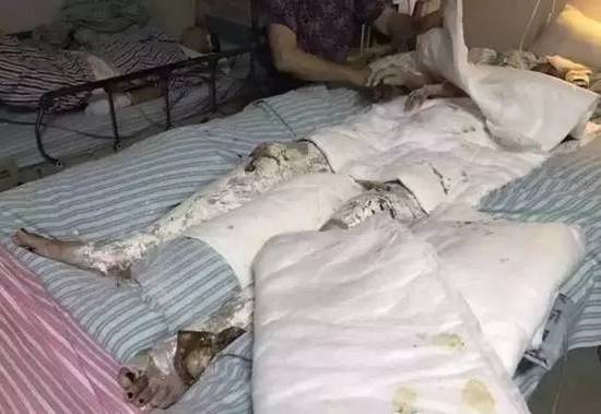 23岁女硕士因碰煤气罐瞬间变火人 全身70%烧伤