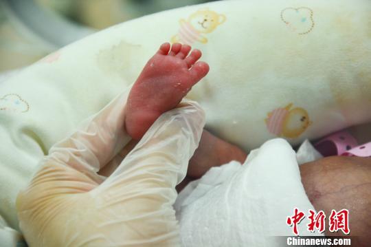 重庆袖珍双胞胎出生40天历险记：姐姐出生时仅490克