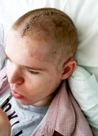 16岁少年遇车祸失去半边脑袋重新开始学走路说话