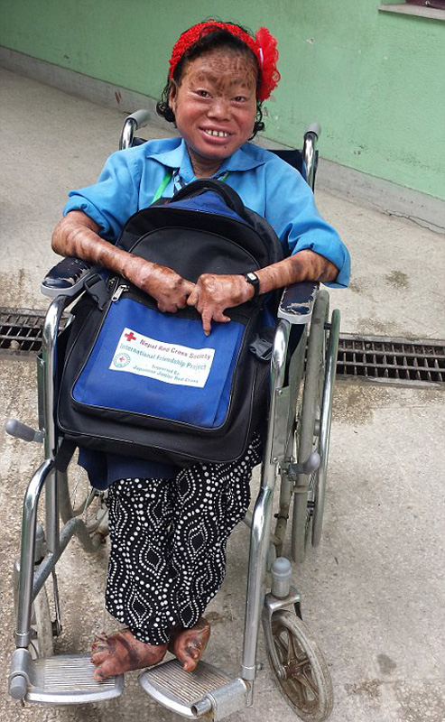 少女患怪病全身长满鱼鳞癣