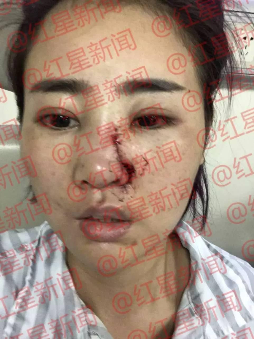 毁容女孩公开近照 毁容女孩公开近照