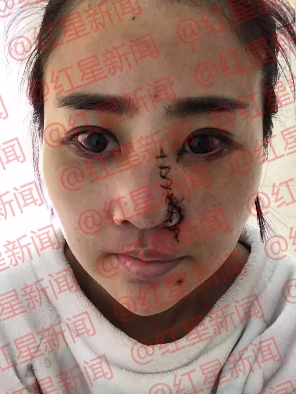 毁容女孩公开近照 毁容女孩公开近照