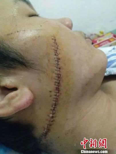 河北隆尧回应中学生割脸事件 校长被警告处分(图)