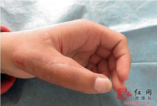 常德15岁女孩疑患罕见病 拇指退化成鸟爪