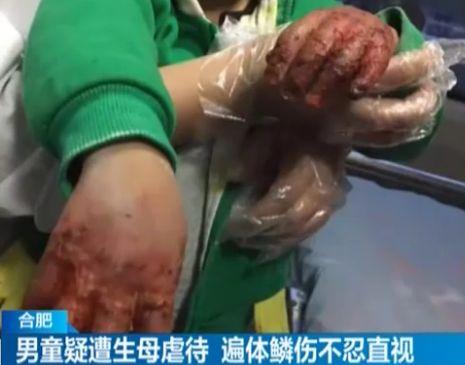男童疑遭生母虐待双手臀部惨不忍睹医院下病危通知书