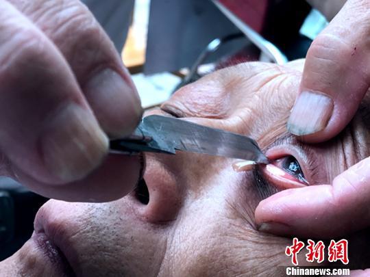 揭秘"刀锋洗眼"绝技:刀片贴着眼球划过(图)