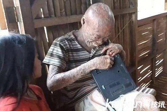 男子全身长满鱼鳞靠疼痛止痒从小被看成怪物孤立无援