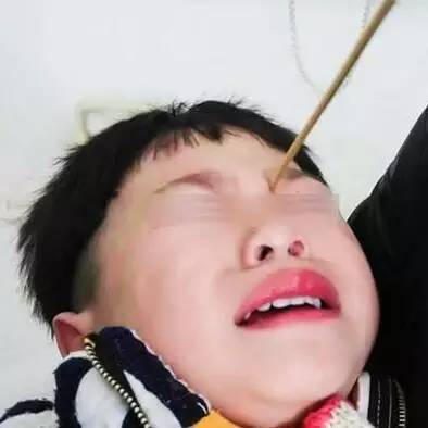 景德镇6岁女童边玩边吃热狗竹签从嘴戳进脊椎