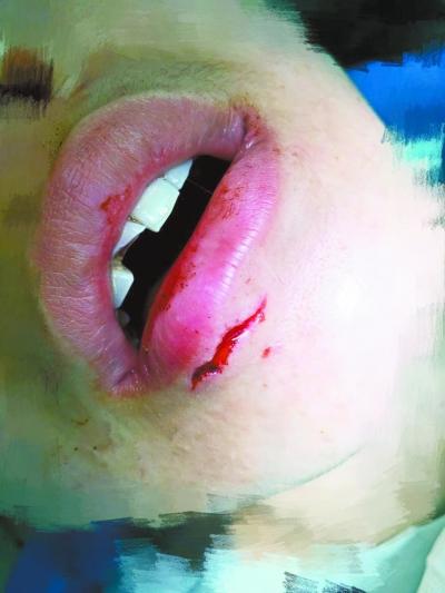 女子喝水时玻璃杯突爆裂致当场昏迷一门牙被崩断