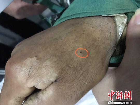 农户被黑寡妇咬伤昏迷17天剧烈抽搐致门牙断裂