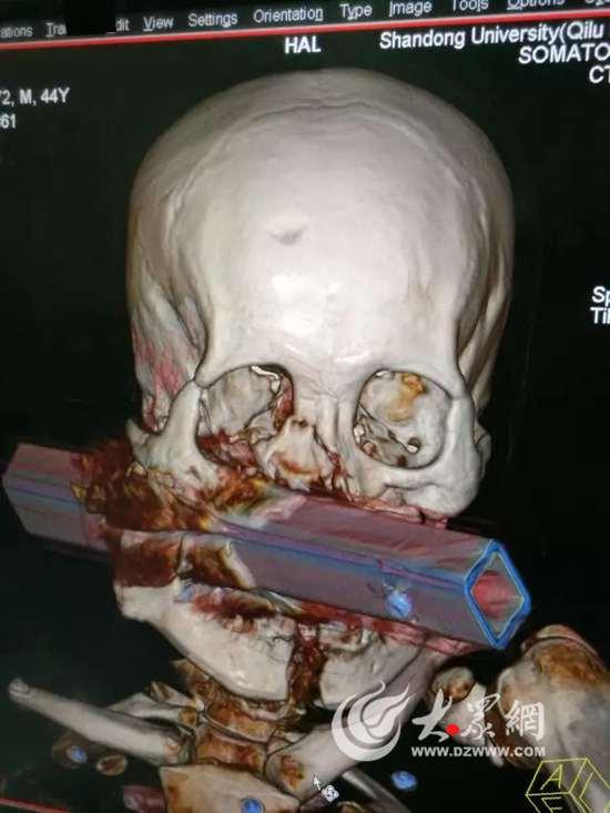 车祸致65厘米钢管穿脸医生抱着患者手术俩小时